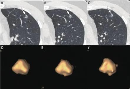 不同类型良恶性肺结节生长曲线绘制与观察